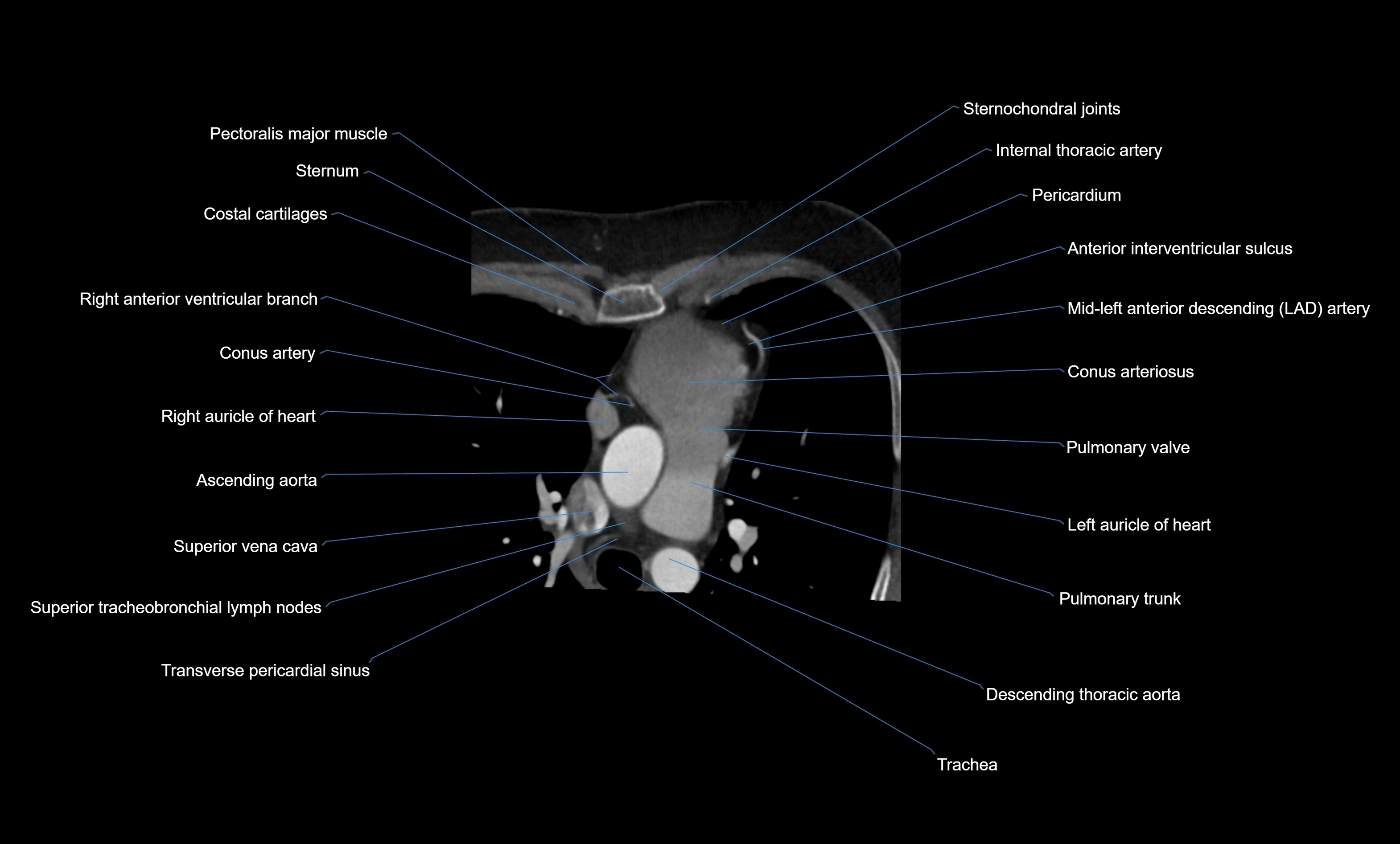 CT heart (coronary angiogram) four chamber view  cross sectional anatomy labelled radiology image -00015.webp